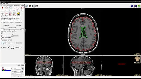 Analyze 15.0 - Segment: Auto Trace