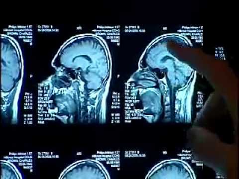 Warning Signs of Stroke