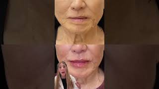 Fixing Lip Asymmetry & Fine Lines 💉 Natural Results Explained by Our PA | Before & After