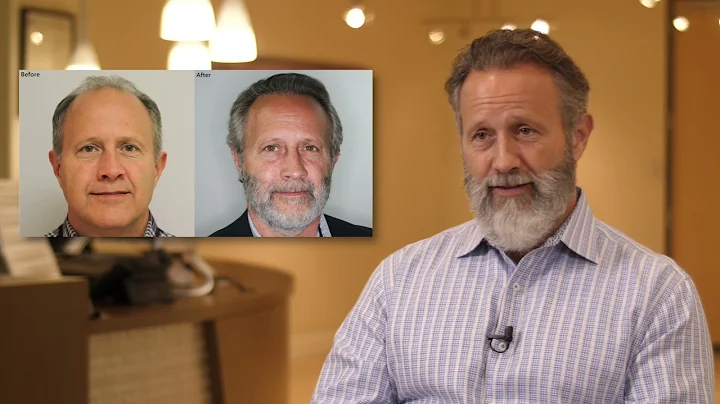 Norwood Hair Loss 5 Classification FUE Hair Transp...
