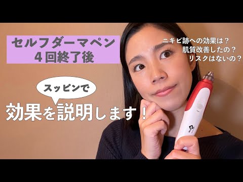 This is what I got good results by getting microneedling at home