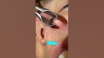 UNUSUAL BUMP IN NOSE - DR. TANVEER JANJUA - NEW JERSEY