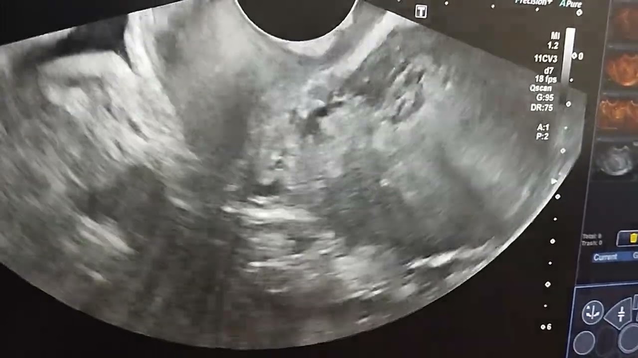 Cystic endometrial hyperplasia#ultrasound 