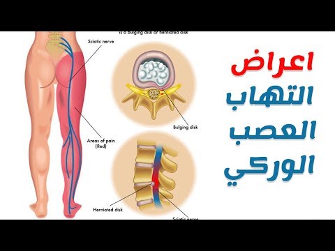 فيديو: جذر الإصبع ، أو Dactyloriza