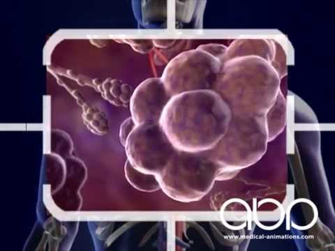 Bronchitis - YouTube