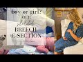 Boy or Girl? Breech C Section