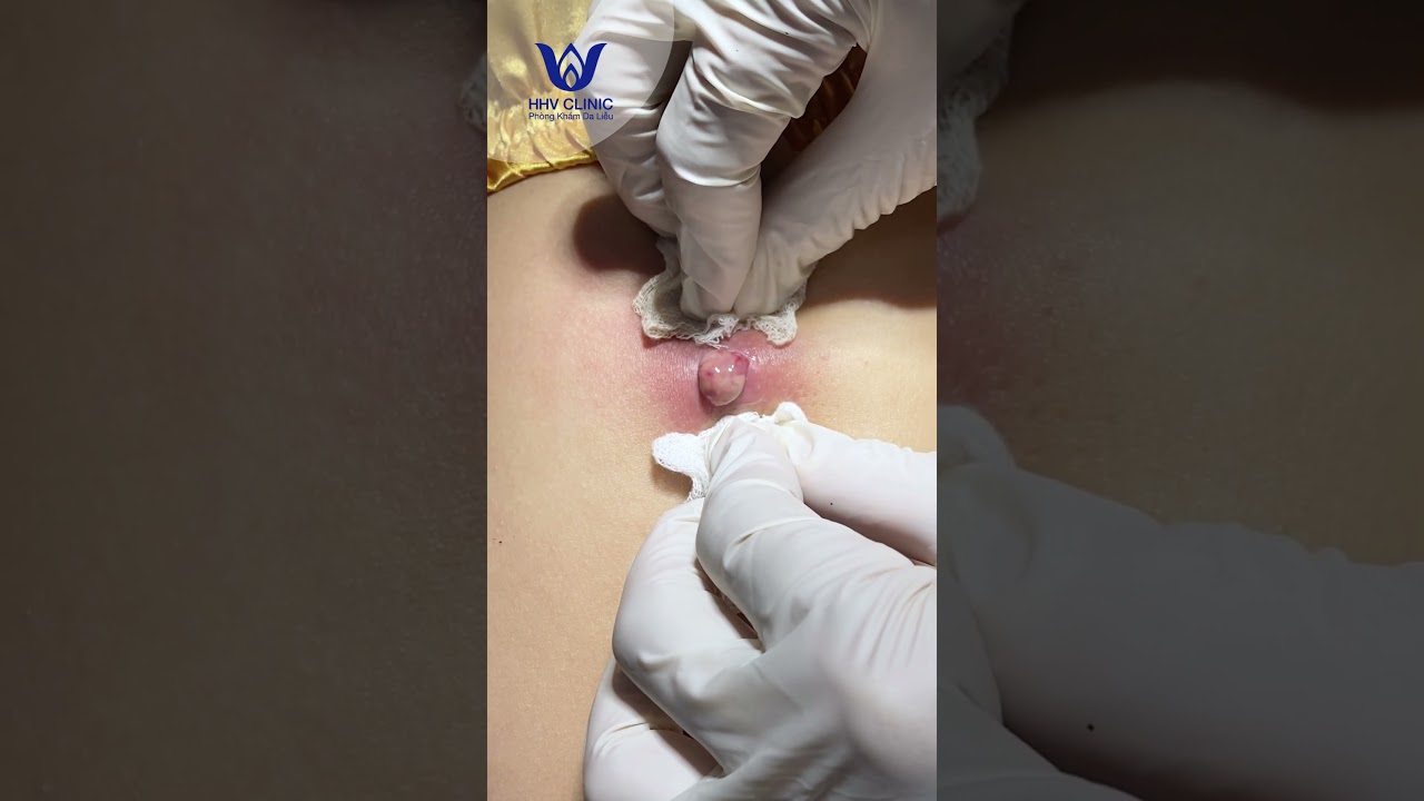 Nặn mụn nhọt ở lưng.