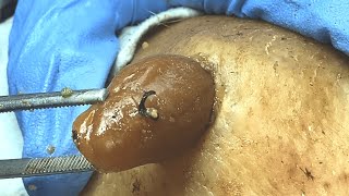 𝑭𝒂𝒄𝒊𝒂𝒍 𝑪𝒍𝒆𝒂𝒏𝒔𝒊𝒏𝒈 𝑪𝒚𝒔𝒕𝒊𝒄 𝑨𝒄𝒏𝒆 𝑹𝒆𝒎𝒐𝒗𝒂𝒍 & 𝑰𝒏𝒇𝒍𝒂𝒎𝒎𝒂𝒕𝒐𝒓𝒚 𝑨𝒄𝒏𝒆 𝒇𝒐𝒓 𝑰𝒏𝒏𝒆𝒓 𝑷𝒆𝒂𝒄𝒆 3514