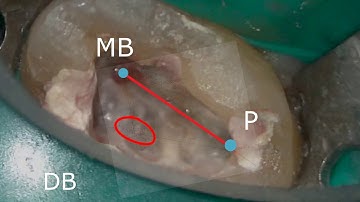 Locating distobuccal canal orifice of maxillary second molar