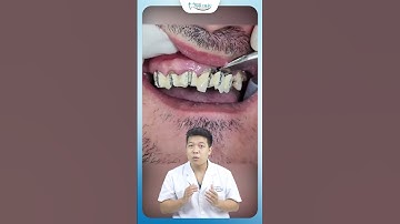 Sự Thật Về Cầu Răng Sứ Kim Loại | Nha Khoa Minh Châu