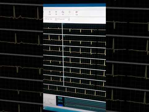 شاشة رسم قلب بالمجهود لمريض والتاكيد على سلامة الشرايين