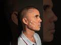 Full Face — это гармонизация черт лица с учетом анатомии, особенностей лица и ваших пожеланий