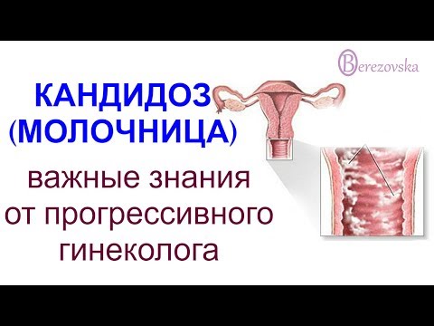 Др. Елена Березовская - О кандидозе (молочнице)
