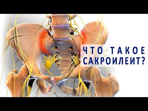 Что такое сакроилеит и как он лечится?