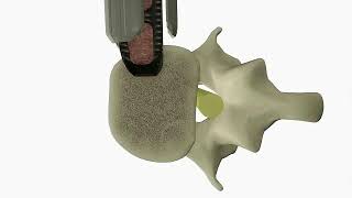Lateral interbody fusion