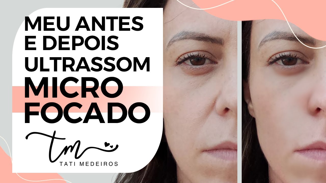 Fiz ULTRASSOM MICROFOCADO - Conto Tudo ( Preço, Doeu, Antes e Depois ...