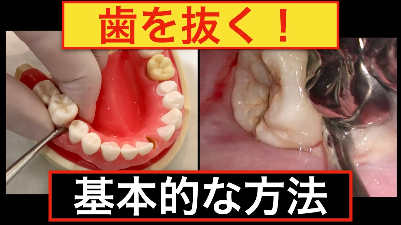 歯 を 痛く なく 抜く 方法