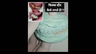 फिक्स दाँत कैसे लगवाए?fix teeth bridge #shorts