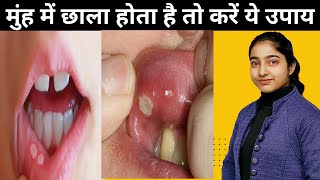 मुंह में छाला होता है तो करें ये उपाय|Mouth ulcers in hindi |Alka Thakur|