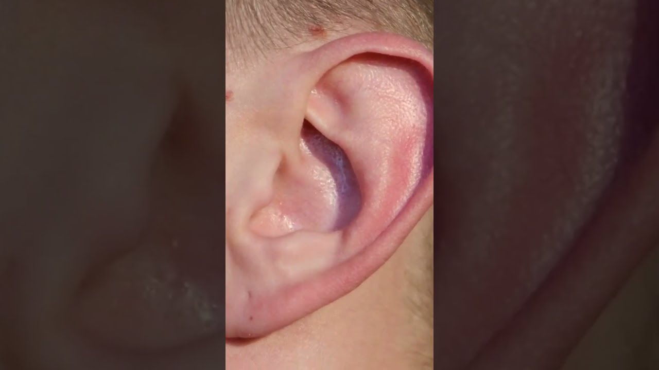 Tinnitus EXPOSED Surprising Causes Of Ringing In Ears 6