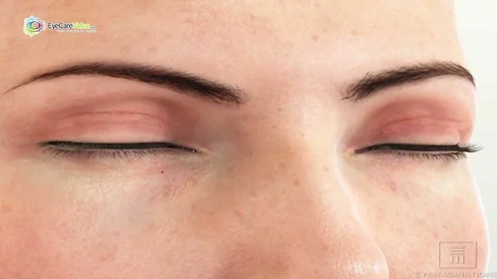 Dr. Robert C. Layman - Dry Eye Treatment