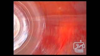 Endoscopic components separation for loss of domain ventral hernia