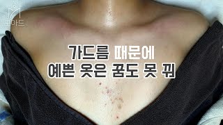 가슴 여드름 가드름 모낭염 자국 개선 후기 (Chest acne skin care review) - 건대 피부관리 모아드