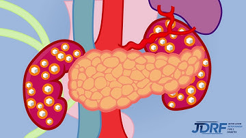 Wat is Type 1 Diabetes?