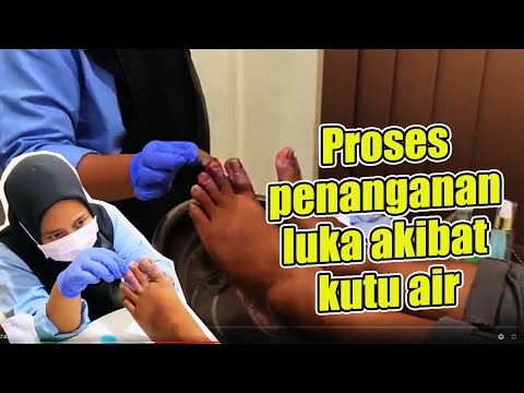 Proses penanganan luka akibat kutu air