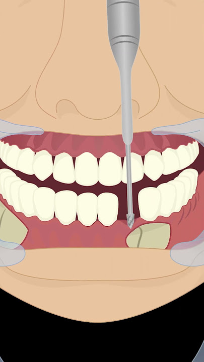 Key Steps for Mandibular Fracture Repair #surgery #fyp #surgeon #jaw #fracture #tooth #ortho #ENT