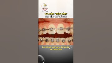 Quy Trình Niềng Răng #kienthucthuvi #niengrang #niengrangmaccai