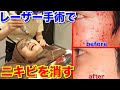 【ニキビ手術】肌荒れを高速で治すレーザーで美肌になりすぎた
