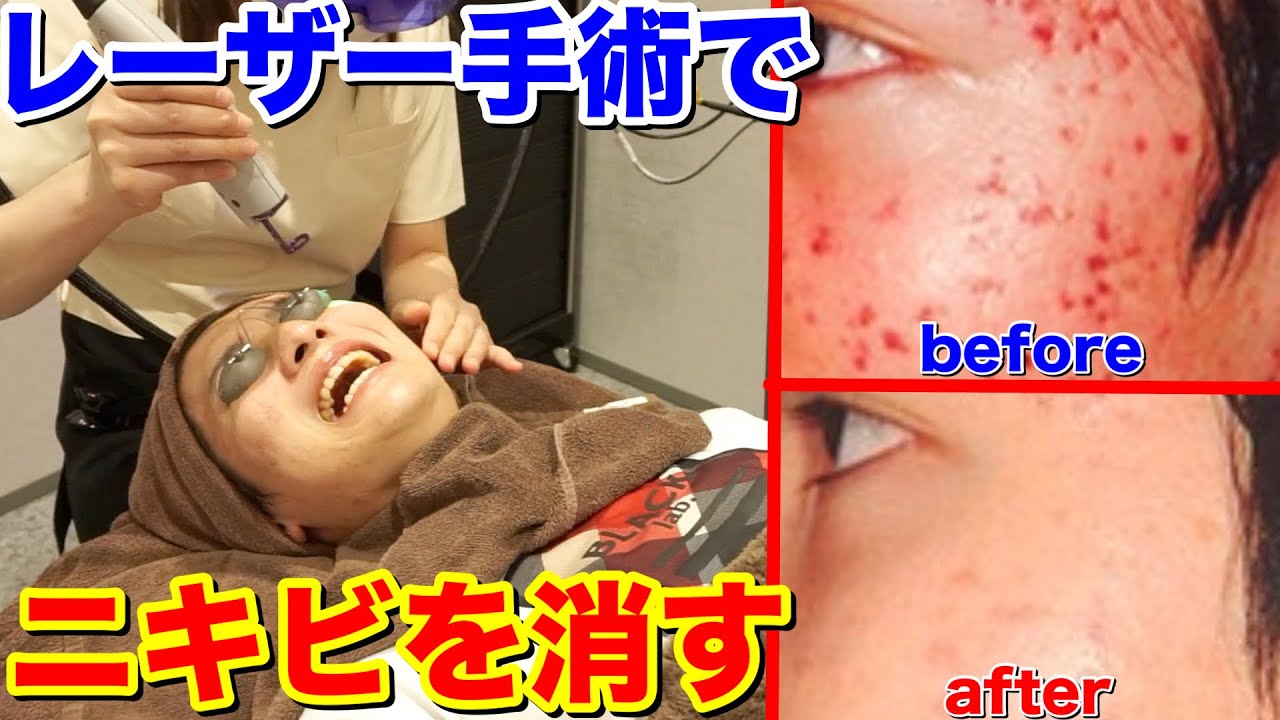 ニキビ手術 肌荒れを高速で治すレーザーで美肌になりすぎた Youtube ニキビ手術 肌荒れを高速で治すレーザーで美肌になりすぎた Youtube