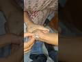 iv cannula technique#motivation #ivcannula #cannula #medicaldevice