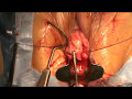 Chirurgie de Prolapsus avec interposition autologue trans obturateur