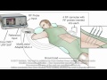 Introduction of an alternative radiofrequency technique for sacroiliac joint - Video Abstract 129478