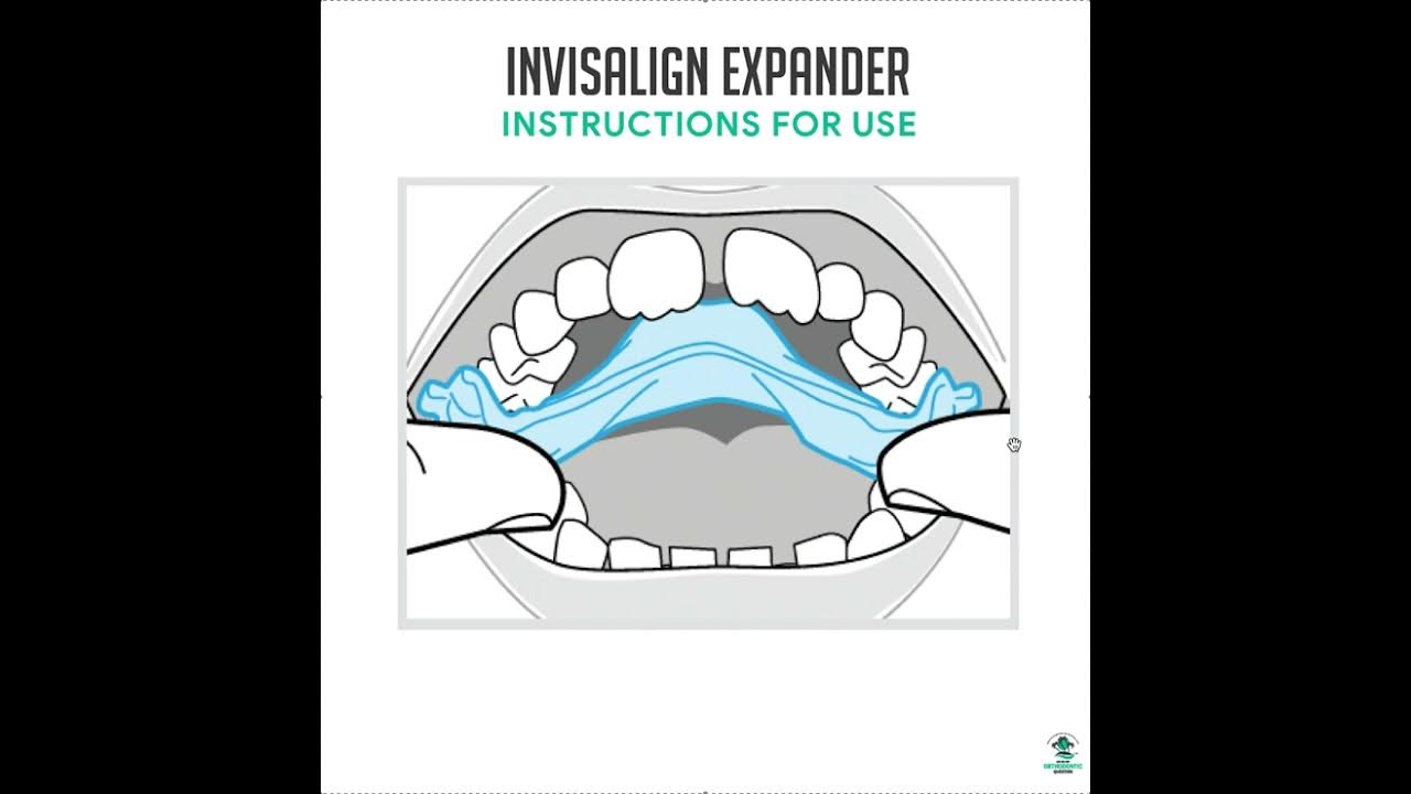 Invisalign Expander ( IPE ) Instructions for Use YouTube