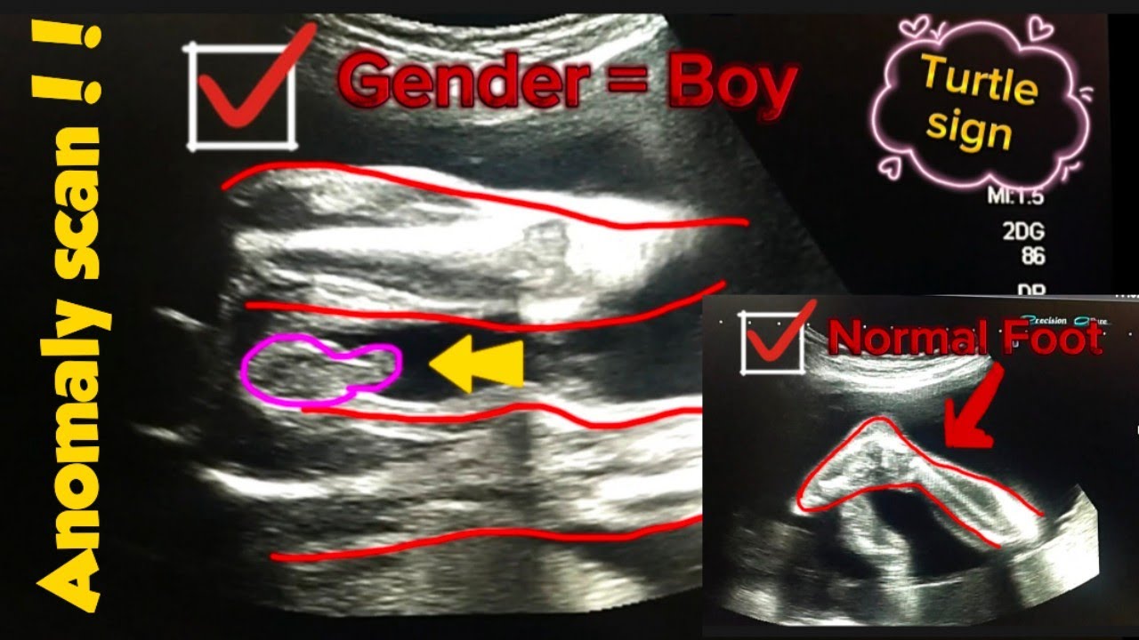 Baby Boy Anomaly Scan Report YouTube Baby Boy Anomaly Scan Report YouTube