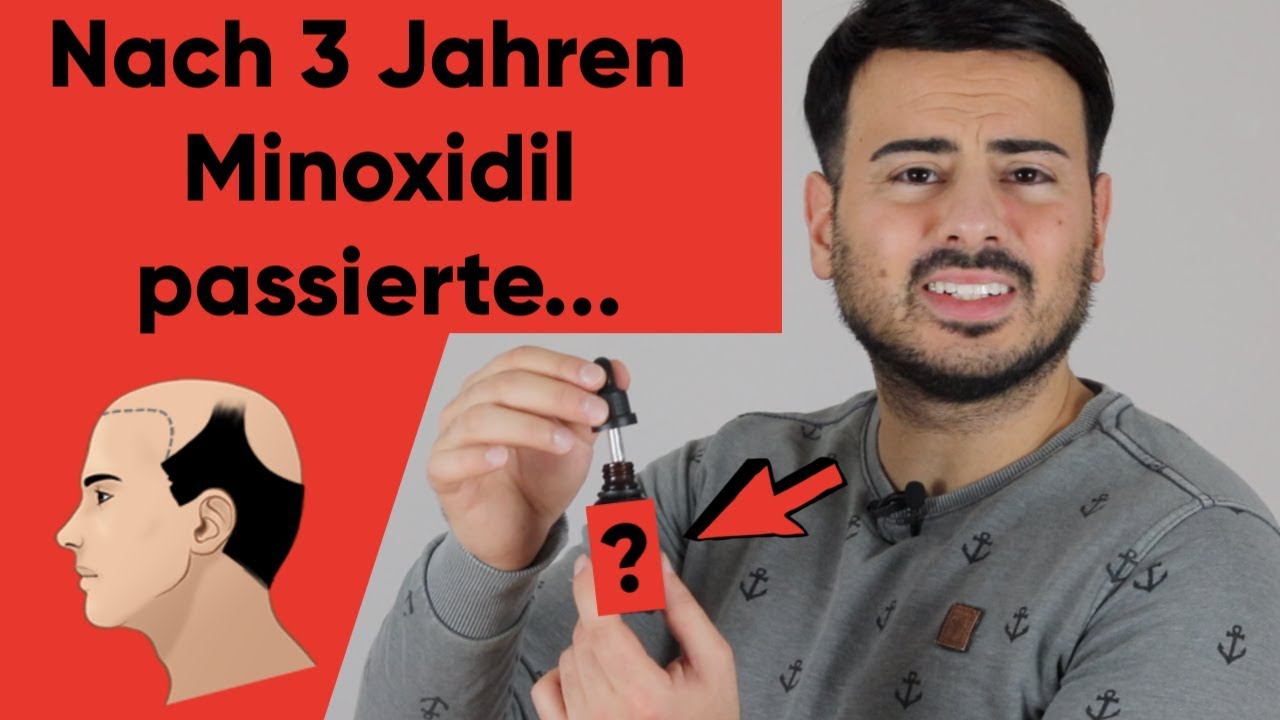 Haarausfall stoppen mit Minoxidil - Meine 3 Jahre Minoxidil Erfahrung - YouTube