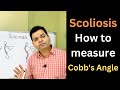 Scoliosis, How to Measure Cobb&#39;s Angle, Scoliosis Treatment, Spine Deformities