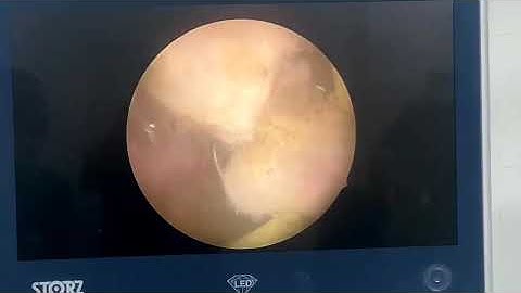 Chuyển giao kỹ thuật bóc nhân tuyến tiền liệt bằng dao đơn cực