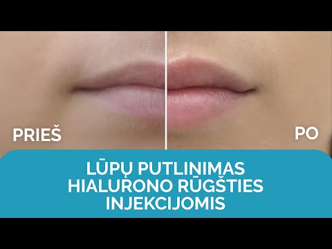 Video: Koldūnai Ir švilpukai: Lūpų Didinimo Klaidos, Pavertusios žvaigždes Antimis