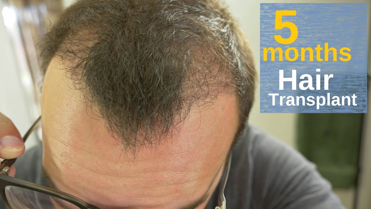 Our patient five months later the third hair transplant  Download  Scientific Diagram