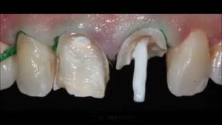 Restaurare dinte cu pivot fibra de sticla si plomba compozit/Tooth  restauration with fiber post! - YouTube
