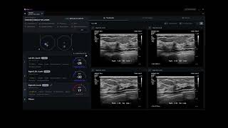 Mobile Breast Ultrasound Analysis AI software screenshot 3