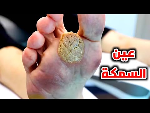 ماهي عين السمكة وشاهد كيف يتم إزالتها     3  