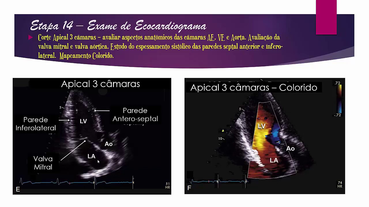 Episódio 14: Corte Apical 3 câmaras
