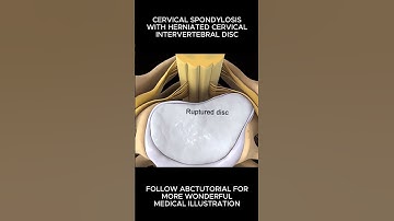 3D-illustratie van cervicale spondylose en een hernia in de cervicale wervelkolom (nekregio).