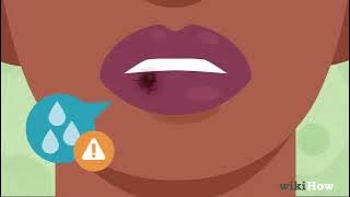 How to Heal Lips After Biting Them