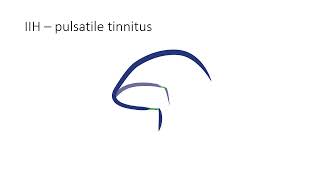 Intracranial Starling Resistor